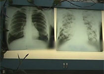 Tuberculoza – între indiferenţă şi tratament forţat
